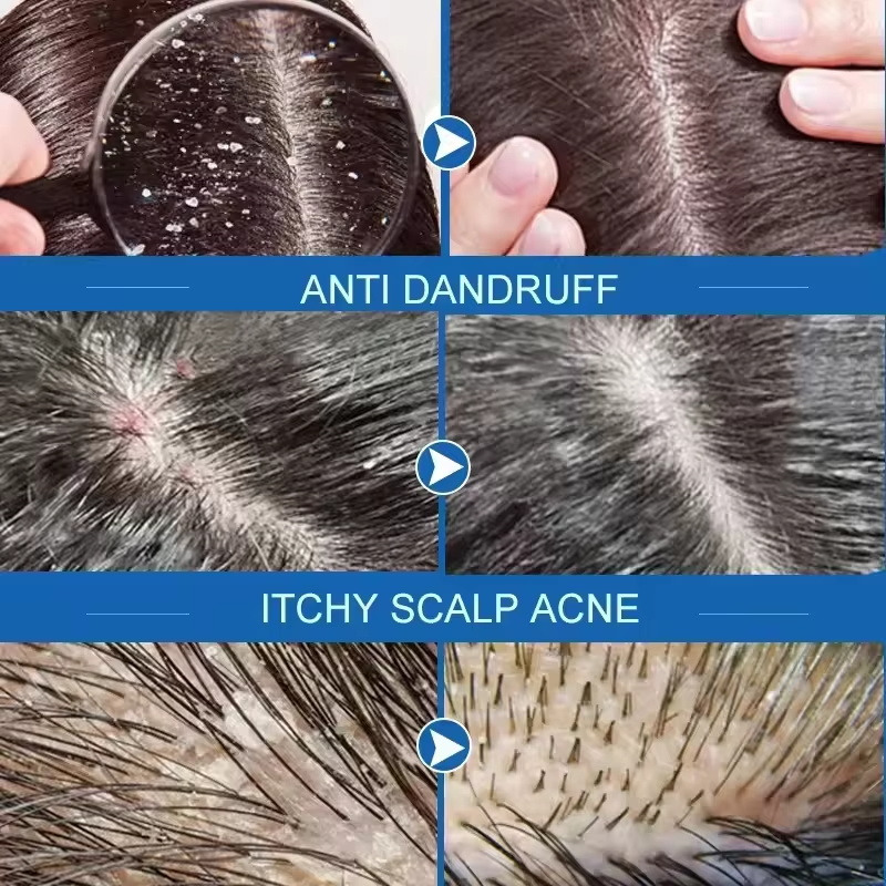 Fast Anti Dandruff Hair Treatm - Hair Care Dandruff recensie en prijs