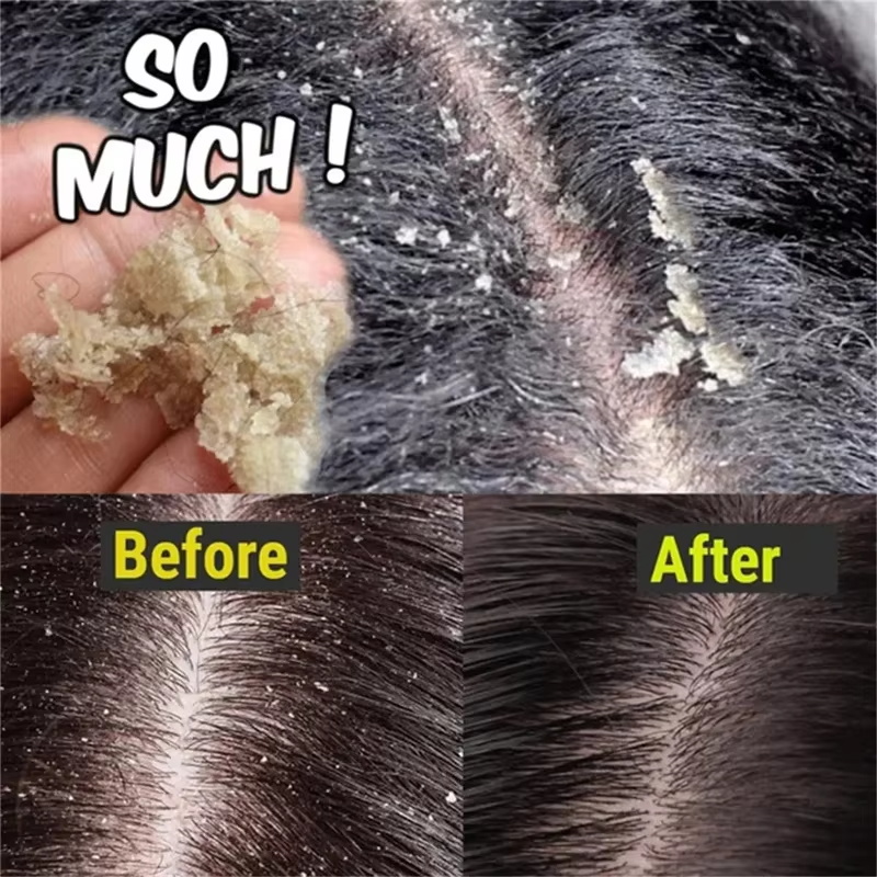 Fast Anti Dandruff Hair Treatm - Hair Care Dandruff recensie en prijs